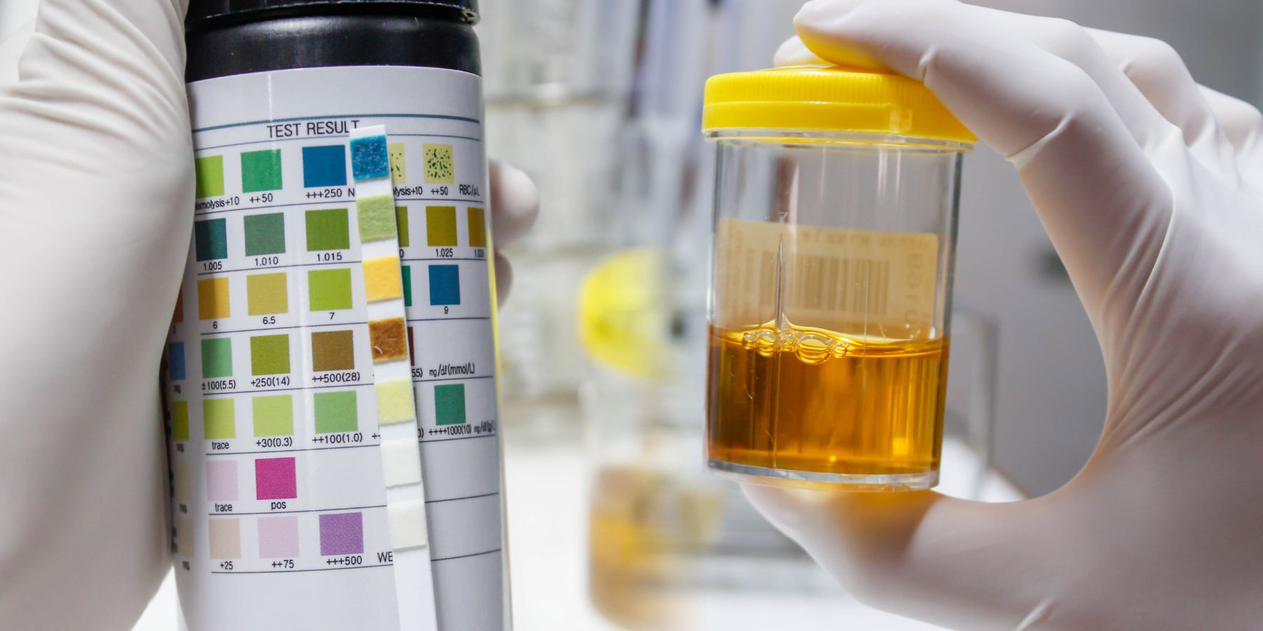Dark Yellow Urine Decoded – What Your Body Is Telling You Understanding Urine Color