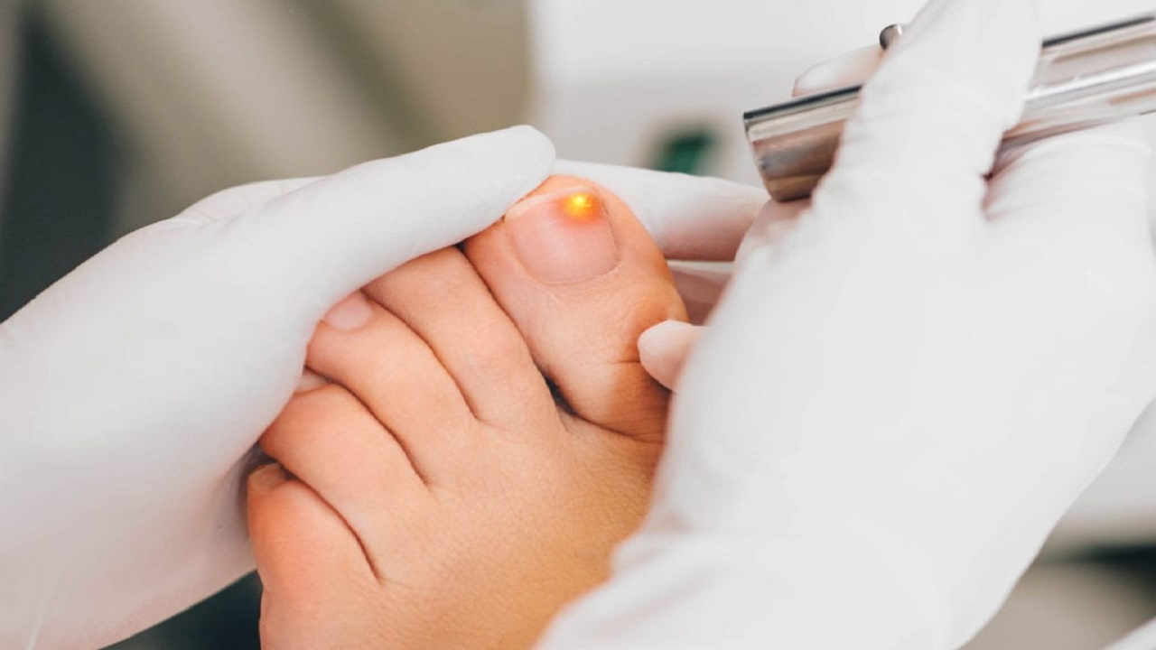 Nail Fungus Laser Treatment: Understanding the Healing Process